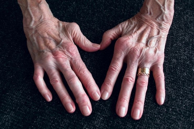 Rheumatoid-Arthritis